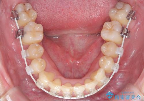 前歯のデコボコと深い咬み合わせを解消の治療中