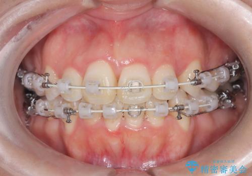 前歯のデコボコと開口を改善し、美しい口元への治療中