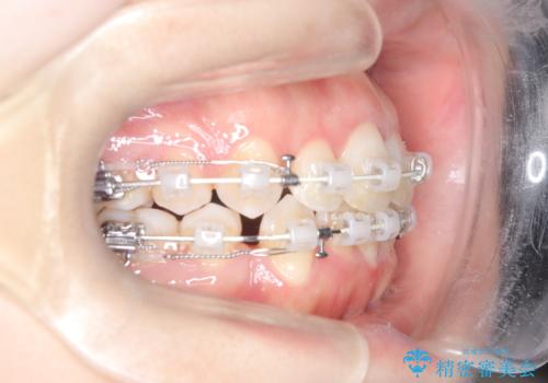 前歯のデコボコと開口を改善し、美しい口元への治療中