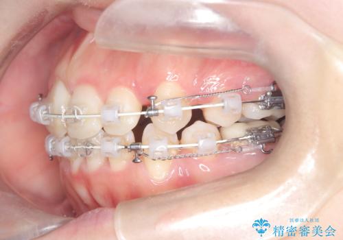 前歯のデコボコと開口を改善し、美しい口元への治療中