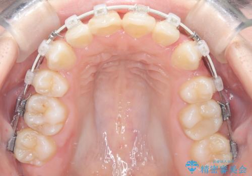 前歯のデコボコと開口を改善し、美しい口元への治療中