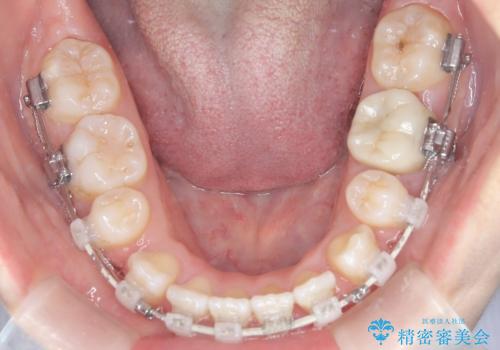 前歯のデコボコと開口を改善し、美しい口元への治療中