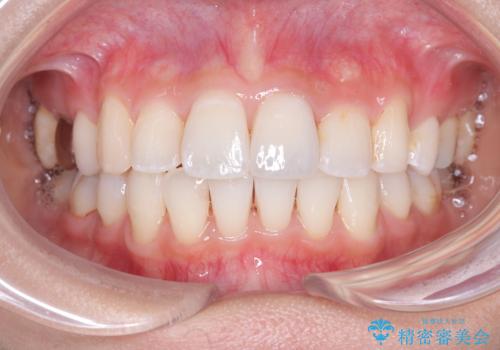 目立たない矯正で口元をすっきりとの症例 治療後