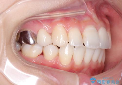 目立たない矯正で口元をすっきりとの治療後