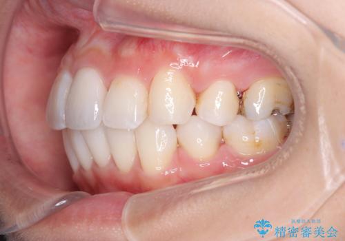 目立たない矯正で口元をすっきりとの治療後