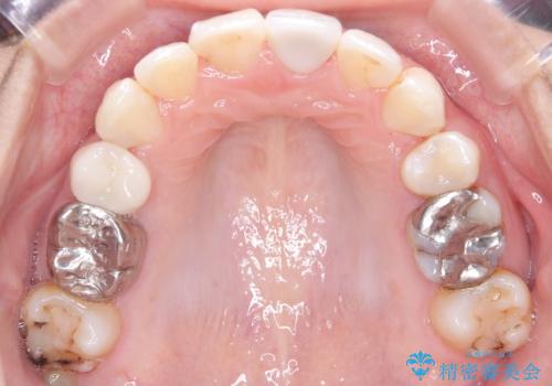 目立たない矯正で口元をすっきりとの治療後