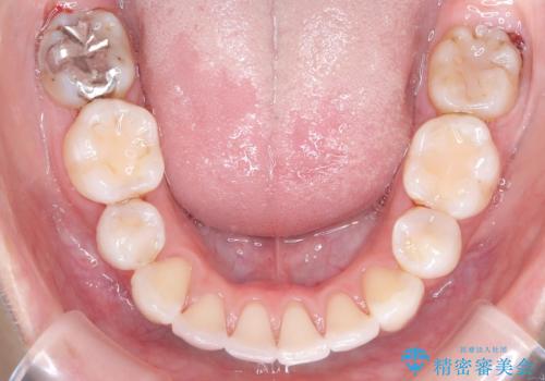 目立たない矯正で口元をすっきりとの治療後