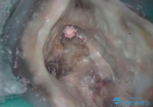 歯のひび割れによる奥歯の痛みも即日解決