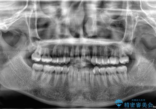 目立たないマウスピース矯正で下の前歯のデコボコをスッキリ解消!たった1年で整った歯並びにの治療前