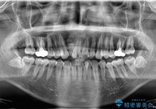 1年でここまで変わる!歯列のがたつきと正中のズレを改善した矯正治療(メタルブラケット×MARPE)の治療前