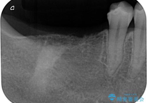 挺出歯を圧下してスペースを確保!目立たない部分矯正で下顎大臼歯にインプラント治療を実現の治療前