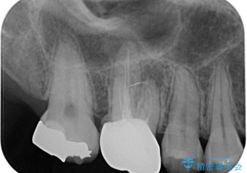 挺出歯を圧下してスペースを確保!目立たない部分矯正で下顎大臼歯にインプラント治療を実現の治療前