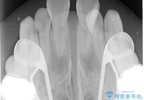 1年でここまで変わる!歯列のがたつきと正中のズレを改善した矯正治療(メタルブラケット×MARPE)の治療中