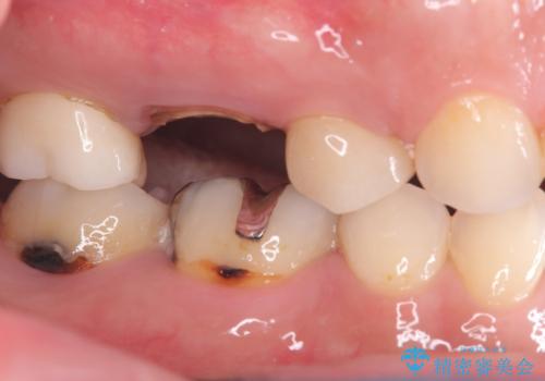 歯のひび割れによる奥歯の痛みも即日解決の治療前