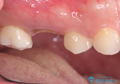 歯のひび割れによる奥歯の痛みも即日解決の治療前