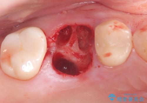 歯のひび割れによる奥歯の痛みも即日解決の治療中
