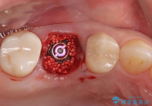 歯のひび割れによる奥歯の痛みも即日解決の治療中