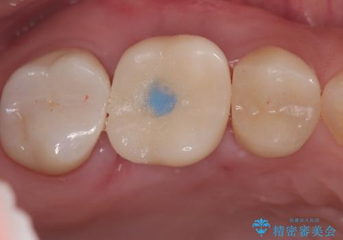 歯のひび割れによる奥歯の痛みも即日解決の治療中