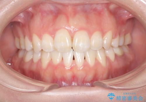 前歯のデコボコと開口を改善し、美しい口元への症例 治療後