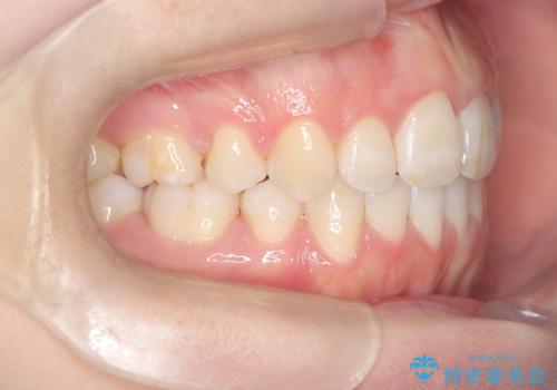 前歯のデコボコと開口を改善し、美しい口元への治療後
