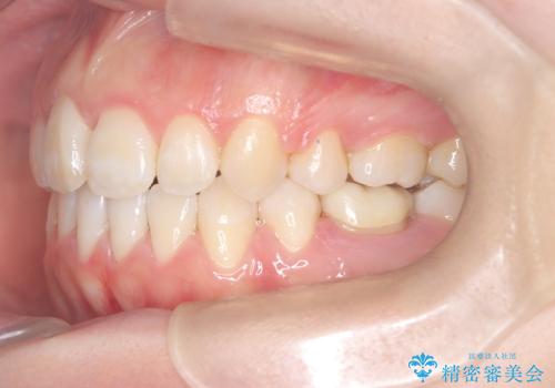 前歯のデコボコと開口を改善し、美しい口元への治療後