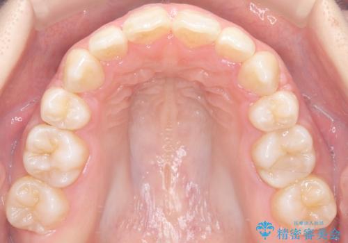前歯のデコボコと開口を改善し、美しい口元への治療後