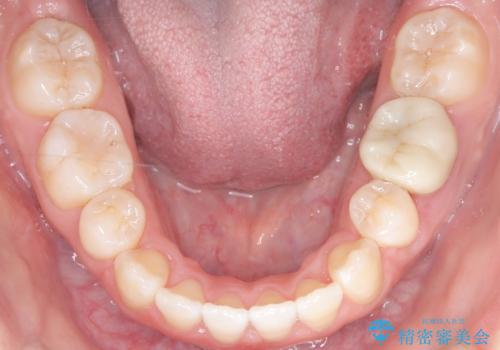 前歯のデコボコと開口を改善し、美しい口元への治療後