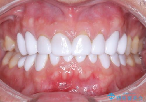 前歯のクラウンをやり変え、歯肉のラインも美しくの症例 治療前