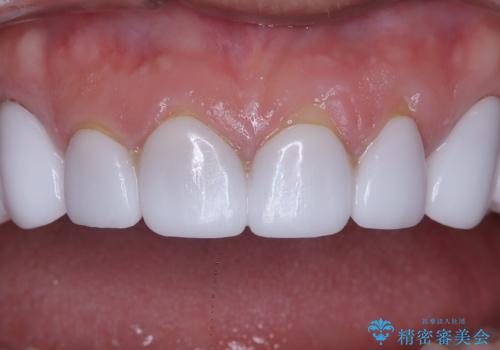 前歯のクラウンをやり変え、歯肉のラインも美しくの治療前