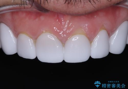 前歯のクラウンをやり変え、歯肉のラインも美しくの治療前