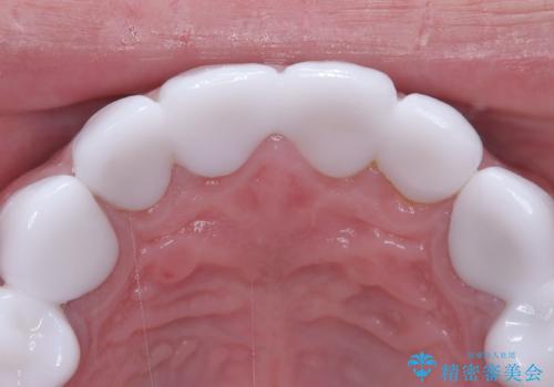 前歯のクラウンをやり変え、歯肉のラインも美しくの治療前