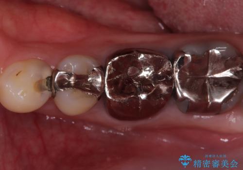 神経を抜かずに深い虫歯を治療の症例 治療前