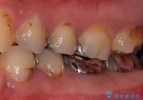 神経を抜かずに深い虫歯を治療の治療前