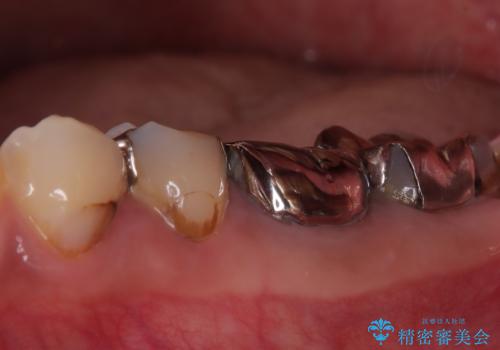 神経を抜かずに深い虫歯を治療の治療前