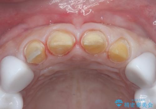 前歯のクラウンをやり変え、歯肉のラインも美しくの治療中