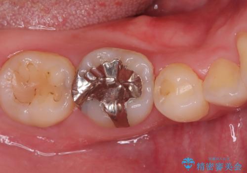 歯の根元の虫歯も精密治療で解決の症例 治療前