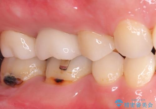 歯の根元の虫歯も精密治療で解決の治療前