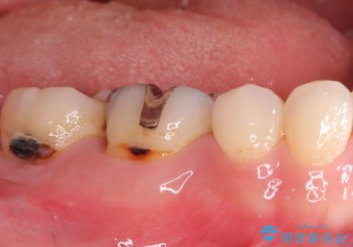 歯の根元の虫歯も精密治療で解決