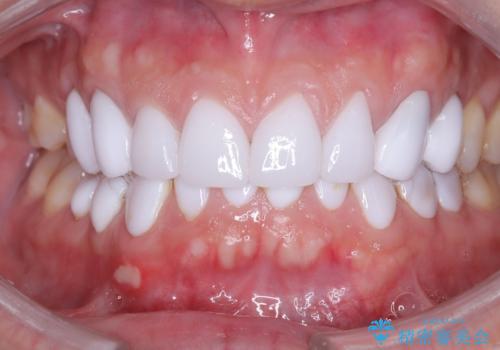 前歯のクラウンをやり変え、歯肉のラインも美しくの症例 治療後