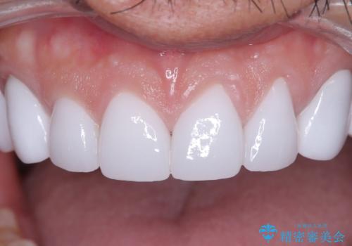 前歯のクラウンをやり変え、歯肉のラインも美しくの治療後