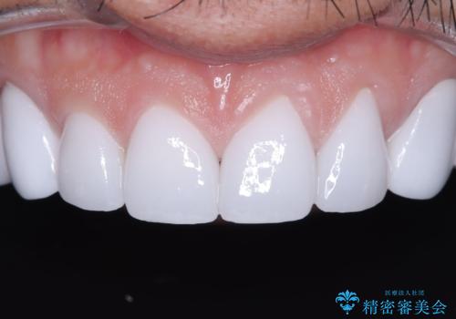 前歯のクラウンをやり変え、歯肉のラインも美しくの治療後