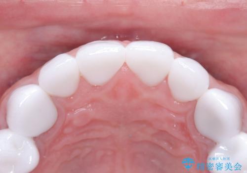 前歯のクラウンをやり変え、歯肉のラインも美しくの治療後