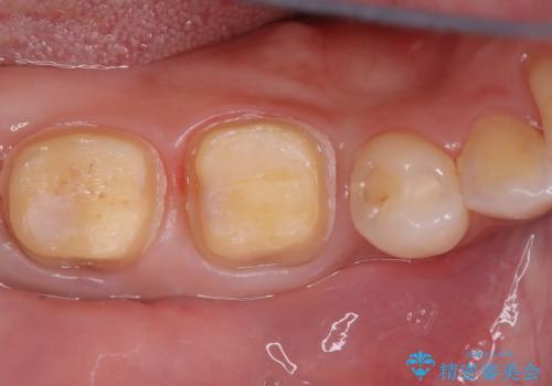 歯の根元の虫歯も精密治療で解決の治療中