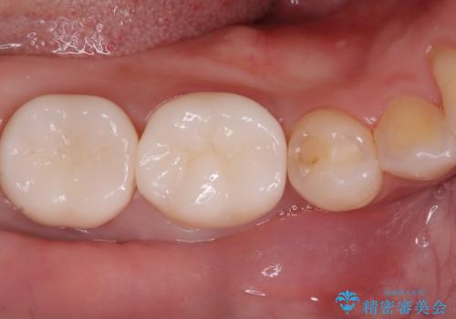 歯の根元の虫歯も精密治療で解決の症例 治療後