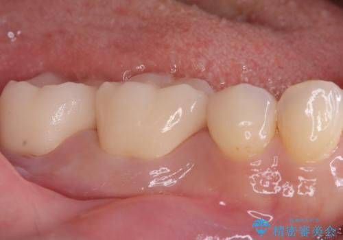 歯の根元の虫歯も精密治療で解決の治療後