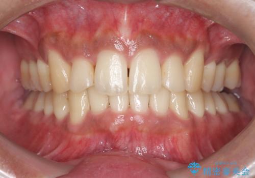 前歯のデコボコと深い咬み合わせを解消の治療後