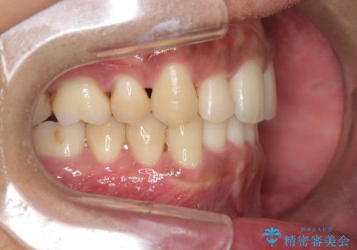 前歯のデコボコと深い咬み合わせを解消の治療後