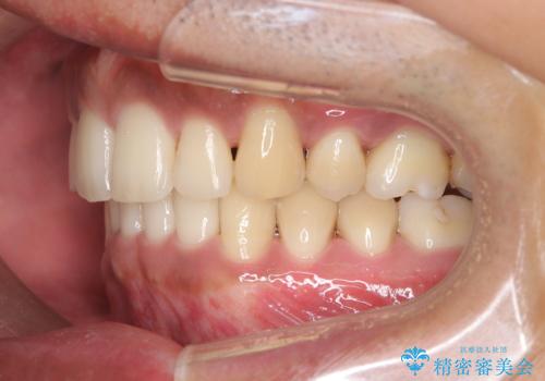 前歯のデコボコと深い咬み合わせを解消の治療後