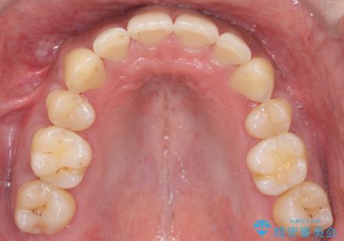 前歯のデコボコと深い咬み合わせを解消の治療後