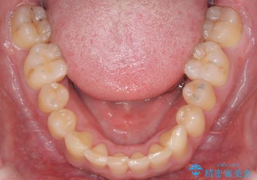 前歯のデコボコと深い咬み合わせを解消の治療後